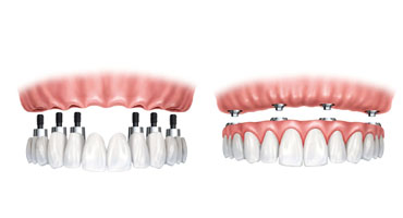 Implant-Náhrada-všech-zubů
