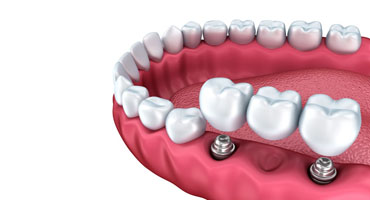 Implantat-Náhrada-více-zubů