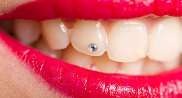 zubni šperk
